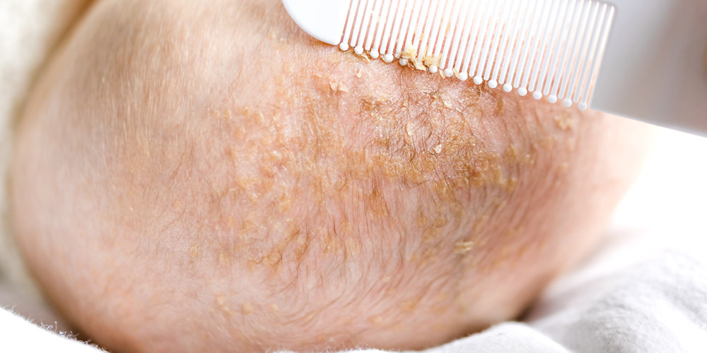 síntomas dermatitis seborreica