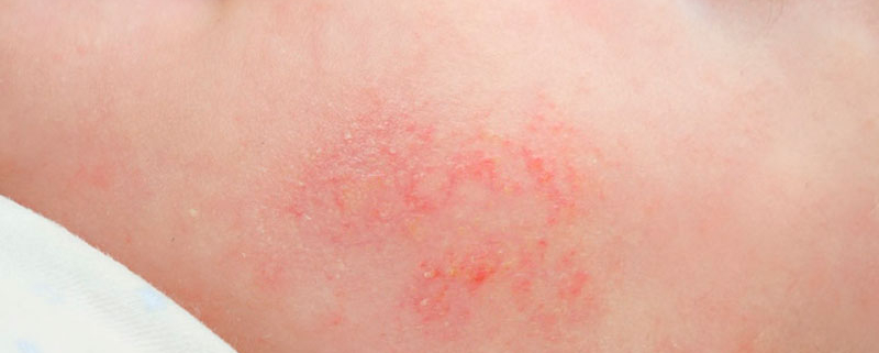 dermatitis-atopica o eccema